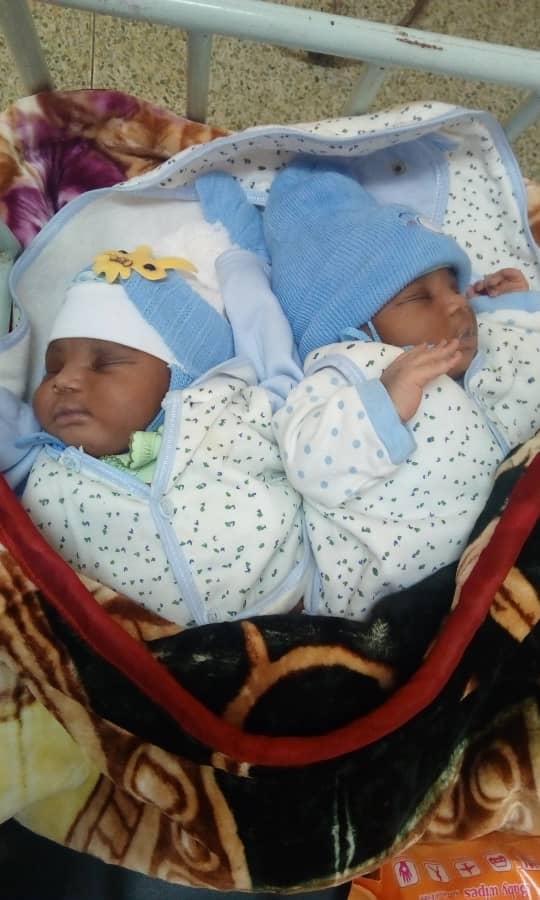 conjoined twins in Yaounde Cameroon